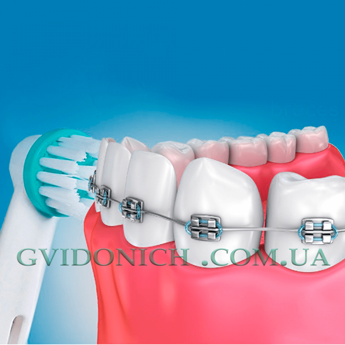 Насадки Ortodontic для ортодонтических брекетов на щетку Braun Oral B  